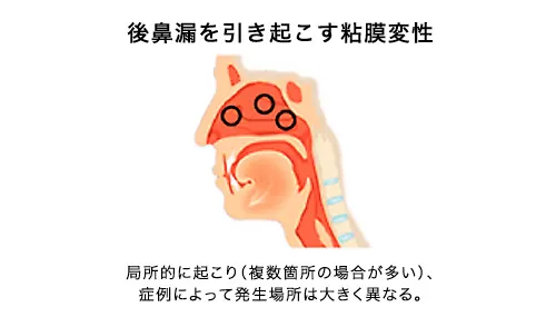粘膜注射療法の後鼻漏治療への適用