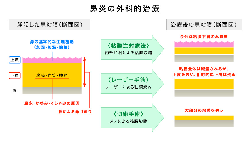 粘膜注射療法の仕組み（鼻炎の場合）