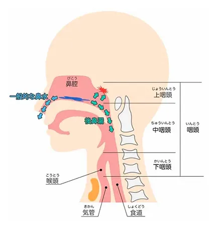 鼻水がのどに落ちる、後鼻漏